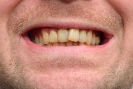 Reduce Teeth Stains