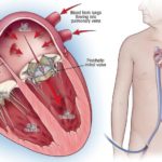 In which Conditions the Valve Replacement Surgery is Needed?