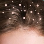 Beware of Dandruff, not Dog. Banish It.