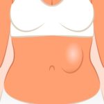 Hiatal Hernia During Pregnancy