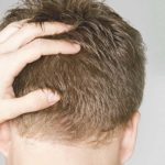 Is This Hair Transplant Technique Cost Effective For The People?