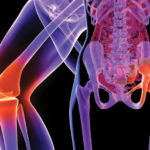 hip joint replacement cost in India