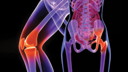 hip joint replacement cost in India