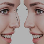 Know all the types of unshaped noses and undergo Rhinoplasty